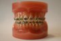 Aparelho Ortodôntico,fotos de Dentaduras(moldes)com braquetes metálico e de cerâmica colados nos dentes(dentaduras do dentista Carlos)
