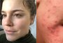 Alice Wegmann sobre acne no rosto: "Batia um desânimo, mas não pode impedir ninguém de viver a vida"