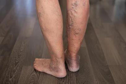 stopabox / adobe.stock.com Patient showing severe varicose veins on legsPatient exhibiting visible varicose and spider veins, highlighting vascular disease and medical condition. Senior elderly person's feet with problem.Fonte: 1969833378<!-- NICAID(16339399) -->
