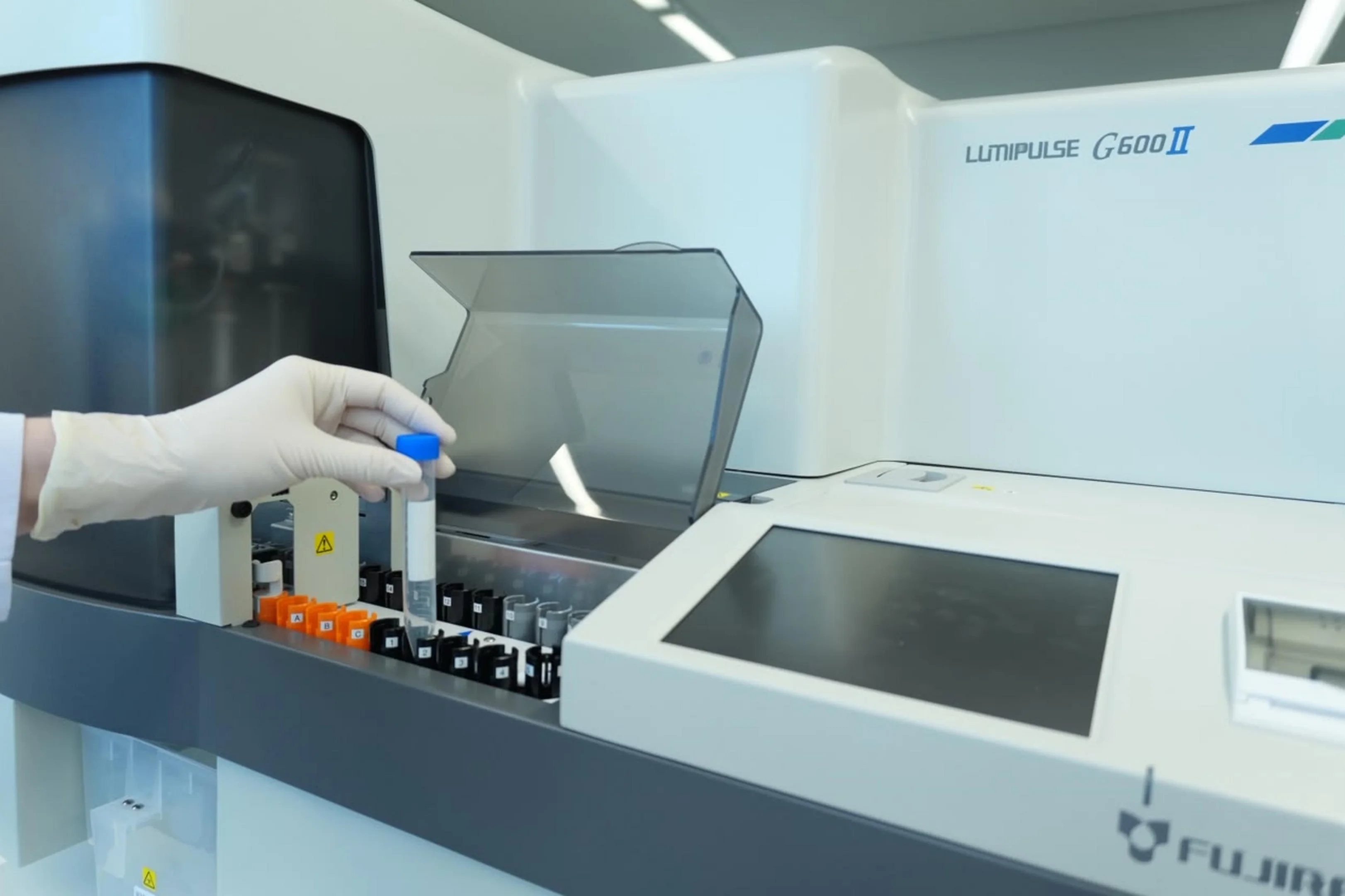Porto Alegre hospital offers Brazil’s first Anvisa-approved Alzheimer’s blood test