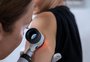 Observação de pintas no corpo é cuidado fundamental para prevenir o câncer de pele