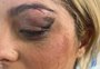 Bebe Rexha mostra machucado no rosto após ser atingida por celular em show