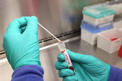 SEATTLE, WA - JULY 12: A swab that tested positive for the Monkeypox virus is seen at the UW Medicine Virology Laboratory on July 12, 2022 in Seattle, Washington. The UW Medicine Virology Laboratory is one of a handful of clinical reference labs in the country to offer laboratory-developed PCR tests for the detection of Monkeypox virus.   Karen Ducey/Getty Images/AFP (Photo by Karen Ducey / GETTY IMAGES NORTH AMERICA / Getty Images via AFP)<!-- NICAID(15155675) -->