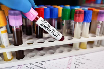 Technician with Blood collection tubes test for analysis of Smallpox and Monkeypox (MPXV). Doctor holding blood tube for MPOX Monkeypox disease test. Foto:  angellodeco / stock.adobe.comFonte: 550259670<!-- NICAID(15844618) -->