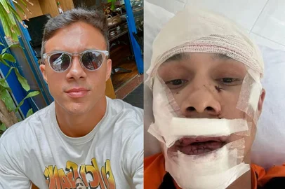 Um homem de 32 anos levou 45 pontos no rosto após ser agredido com um copo em um bar em Águas de Lindóia, no interior de São Paulo. O personal trainer Thiago Medeiros contou que a violência começou depois que ele tentou defender mulheres que estavam sendo importunadas por um homem. As<!-- NICAID(16075865) -->