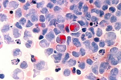 Terapia gênica para tratar câncer. Células cancerígenas. leucemia.<!-- NICAID(15025303) -->
