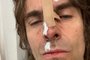 Liam Gallagher mostra ferimentos após cair de helicóptero<!-- NICAID(14893527) -->