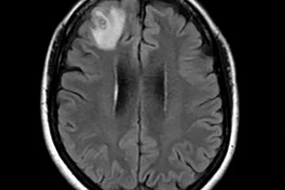 An undated and unplaced handout phooto received from The Australian National University (ANU) in Canberra on August 29, 2023 shows a brain scan. A parasitic roundworm typically found in snakes has been pulled "alive and wriggling" from a woman's brain in a stomach-churning medical first, Australian doctors said on August 29, 2023. (Photo by Handout / THE AUSTRALIAN NATIONAL UNIVERSITY / AFP) / ----EDITORS NOTE ----RESTRICTED TO EDITORIAL USE MANDATORY CREDIT " AFP PHOTO / THE AUSTRALIAN NATIONAL UNIVERSITY" NO MARKETING NO ADVERTISING CAMPAIGNS - DISTRIBUTED AS A SERVICE TO CLIENTSEditoria: HUMLocal: CanberraIndexador: HANDOUTSecao: medicineFonte: THE AUSTRALIAN NATIONAL UNIVERSIFotógrafo: Handout<!-- NICAID(15524831) -->