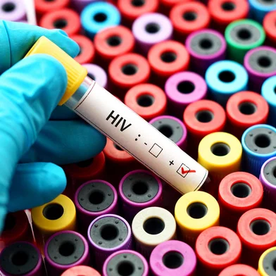 PORTO ALEGRE, RS, BRASIL, 16/10/2016- Amostra de sangue seropositiva. Foto: jarun011 / stock.adobe.comFonte: 125123709<!-- NICAID(14293144) -->