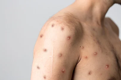 Monkeypox new disease dangerous over the world.*A PEDIDO DE GIOVANNA BATISTA* Varíola do macaco - Foto: Berkay/stock.adobe.comFonte: 505878975<!-- NICAID(15104247) -->