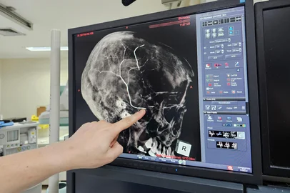 Estudo sobre enxaqueca em Passo Fundo<!-- NICAID(16144988) -->