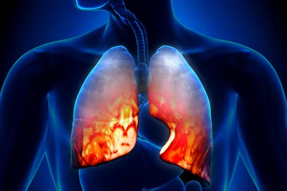 Pneumonia - Lungs Inflammatory ConditionFonte: 66298352<!-- NICAID(15060033) -->