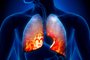 Pneumonia - Lungs Inflammatory ConditionFonte: 66298352<!-- NICAID(15060033) -->