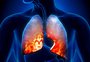 Pneumonia: o que é, quais os sintomas e como tratar