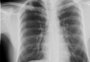 5 sintomas de alerta para a tuberculose