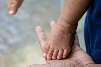 Conceito de enterovirus, coxsackie virus - Foto: Chamli_Pr/stock.adobe.comFonte: 852860185<!-- NICAID(15923271) -->