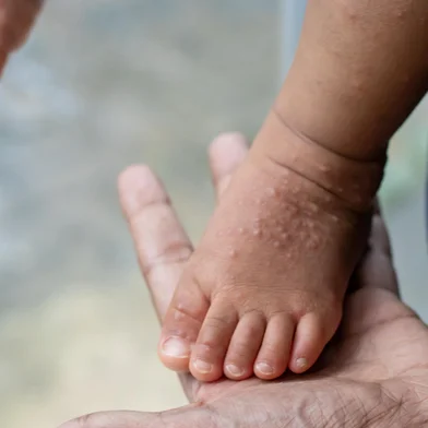 Conceito de enterovirus, coxsackie virus - Foto: Chamli_Pr/stock.adobe.comFonte: 852860185<!-- NICAID(15923271) -->