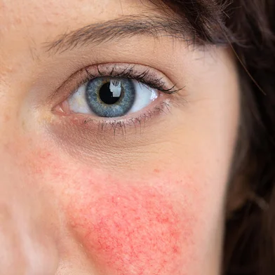 A beautiful young caucasian lady is seen up close and from the front, detailed view of blue iris, red blotchy cheeks symptomatic of couperoseFonte: 304653133<!-- NICAID(14797173) -->