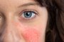 A beautiful young caucasian lady is seen up close and from the front, detailed view of blue iris, red blotchy cheeks symptomatic of couperoseFonte: 304653133<!-- NICAID(14797173) -->