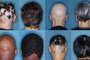 Um novo estudo mostra que um em cada três pacientes com uma doença de pele grave conseguiu fazer o cabelo crescer novamente após ser tratado com um medicamento comum para artrite.O estudo é baseado em ensaios clínicos de Fase 3 usando baricitinibe, um inibidor da Janus quinase (JAK), para tratar a alopecia areata, uma doença de pele frequentemente desfigurante caracterizada pela rápida perda de cabelo no couro cabeludo e, às vezes, de sobrancelhas e cílios.<!-- NICAID(15592605) -->