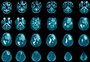 Remédio que bloqueia desenvolvimento do Alzheimer mostra resultados promissores