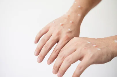 Concept of monkey pox infection, a white Asian man with pustular skin from monkeypox virus infection.varíola dos macacos. Foto:  Somboon / stock.adobe.comIndexador: Somboon KeaoboonsongFonte: 519099018<!-- NICAID(15185052) -->