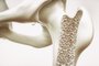 Osteoporosis stage 4 of 4 - upper limb bone - 3d renderingOsteoporose. Foto: crevis / stock.adobe.comFonte: 128396472<!-- NICAID(15470341) -->