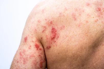 The shingles skin rash located on the back and the back of the arm of an adult male. It is also called zoster or herpes zoster. It is caused by the varicella zoster virus.Fonte: 1595566817<!-- NICAID(16185742) -->