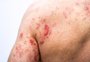 Herpes zóster aos 60+: como reconhecer, tratar e prevenir a doença que pode deixar sequelas
