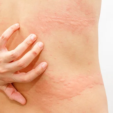 Women with symptoms of itchy urticaria.Fonte: 119502415Fotógrafo: Women with symptoms of itchy urt<!-- NICAID(14516283) -->