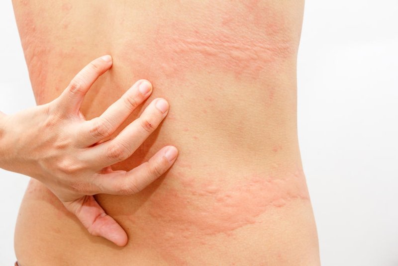 Women with symptoms of itchy urticaria.Fonte: 119502415Fotógrafo: Women with symptoms of itchy urt<!-- NICAID(14516283) -->