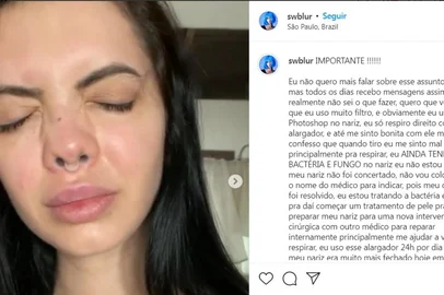 Cirurgião plástico Alan Landecker é investigado por suspeita de deformar nariz de 30 pacientes em São Paulo; na foto, reprodução do desabafo de uma das supostas vítimas, a influencer Sarah Cardoso<!-- NICAID(14933505) -->