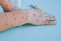 Passo Fundo registra primeiro caso de Mpox em 2024<!-- NICAID(15843981) -->