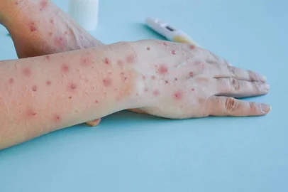Passo Fundo registra primeiro caso de Mpox em 2024<!-- NICAID(15843981) -->