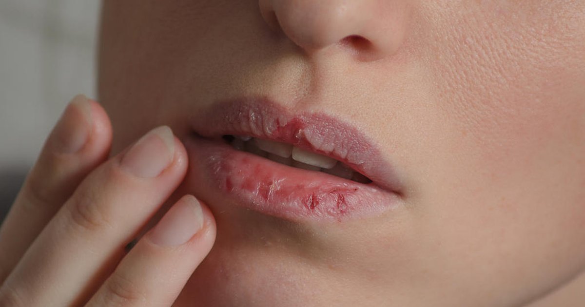 Labios Ressecados O Que Fazer Para Tratar Ressecamento Labial Donna Labios Ressecados O Que Fazer Para Tratar Ressecamento Labial Donna
