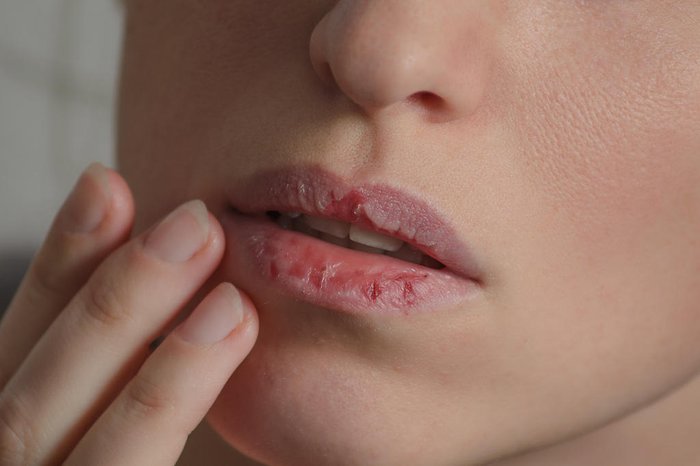 Lábios ressecados: o que fazer para tratar ressecamento labial | Donna