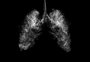 Enfisema pulmonar é a consequência mais frequente do tabagismo