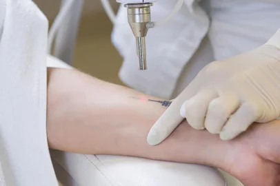 Cosmetologist doing laser tattoo removal from woman hand in cosmetology clinicCosmetologist doing laser tattoo removal from woman hand in cosmetology clinicFonte: 234248919<!-- NICAID(15932450) -->