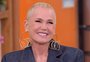 Xuxa revela que fez transplante capilar após diagnóstico de calvície; entenda o que é alopecia androgenética