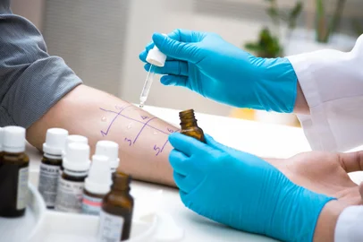 Skin prick allergy to find out kind of allergyIndexador: Alexander RathsFonte: 42903070<!-- NICAID(15475806) -->