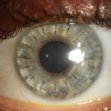 Imagem para ilustrar matéria sobre transplante de córnea no HCPA.<!-- NICAID(15869101) -->