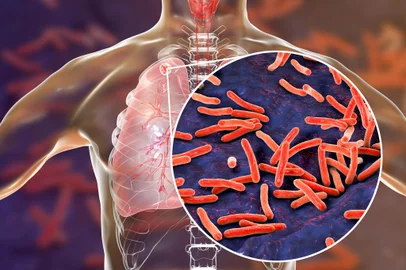 Secondary tuberculosis in lungs and close-up view of Mycobacterium tuberculosis bacteriaSecondary tuberculosis in lungs and close-up view of Mycobacterium tuberculosis bacteria, 3D illustrationFonte: 200411005<!-- NICAID(15510902) -->