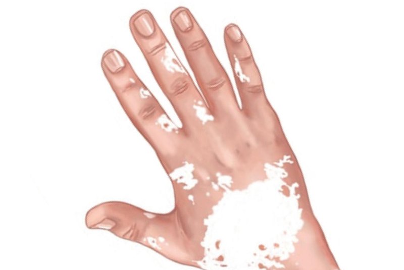 O vitiligo é uma desordem na pigmentação da pele que provoca manchas brancas em várias partes do corpo.<!-- NICAID(14001024) -->