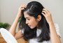 Mulheres também têm calvície? Entenda o que é e como tratar a alopecia androgenética