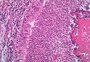 Entenda a fibrose cística, doença genética que afeta mais de 6 mil brasileiros; veja sintomas e tratamento
