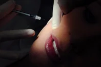 Injeção de Botox na boca aplicada pela dentista Deniela Nadori.<!-- NICAID(5295592) -->