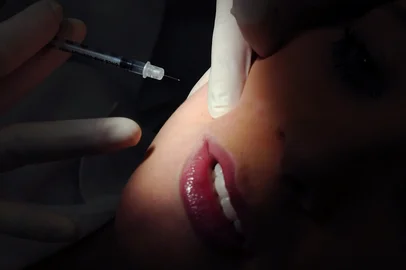 Injeção de Botox na boca aplicada pela dentista Deniela Nadori.<!-- NICAID(5295592) -->