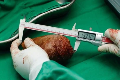 Pedra retirada de paciente pesava 801 gramas e tinha 13 centímetros