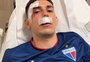 Jogadores do Fortaleza são hospitalizados após ataque a ônibus na saída da Arena Pernambuco