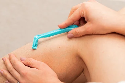 Adobe.Stock - AcneClose up picture of folliculitis on human skin, woman fingers popping it outIndexador: OCSKAY MARKFonte: 333389936<!-- NICAID(15970733) -->